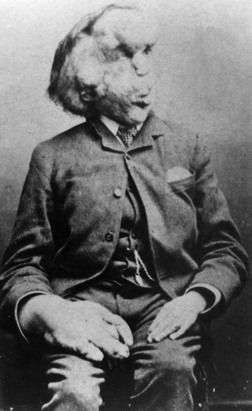 ジョゼフ・メリックの写真